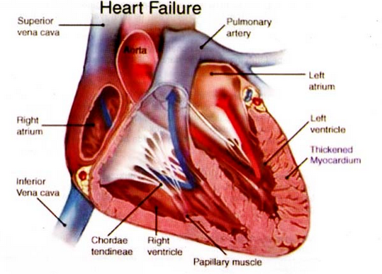 Obat Tradisional Jantung Bocor Pada Anak