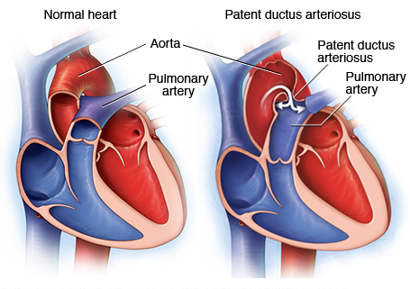 Apakah Jantung Bocor Bisa Sembuh Tanpa Operasi