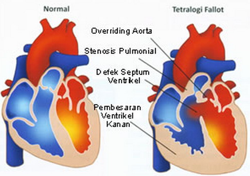 Obat Jantung Bocor Bawaan
