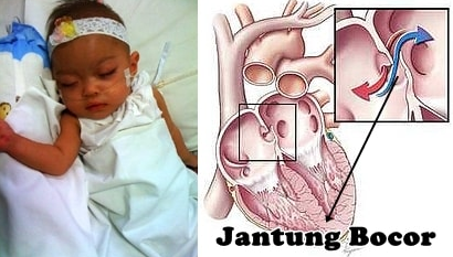 Penyebab Jantung Bocor Pada Anak